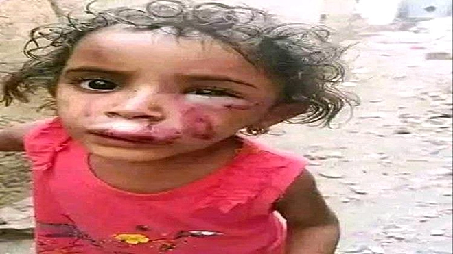 صورة لآثار الضرب على وجه الطفلة صورة لآثار الضرب على وجه الطفلة